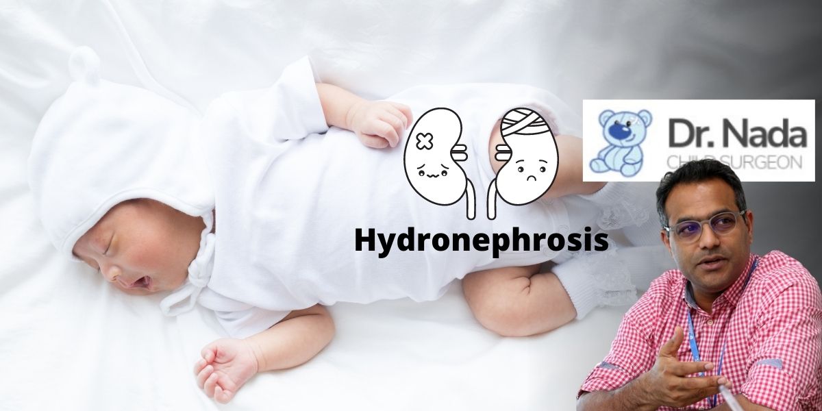 Hydronephrosis Babies
